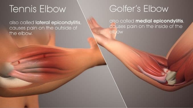 GolferTennisElbow