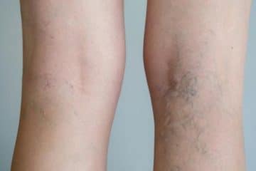 If You Have Varicose Veins, What Are Your Options?