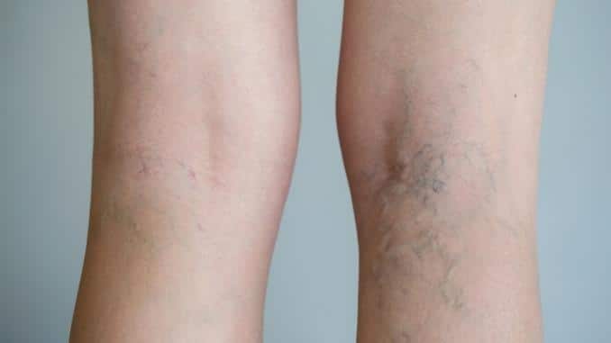 If You Have Varicose Veins, What Are Your Options