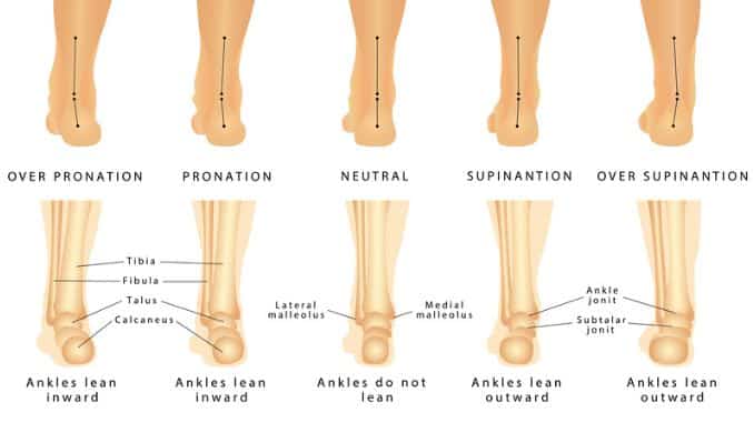 foot-deformation-valgus-varus-defect How to Deal with Shin Splints