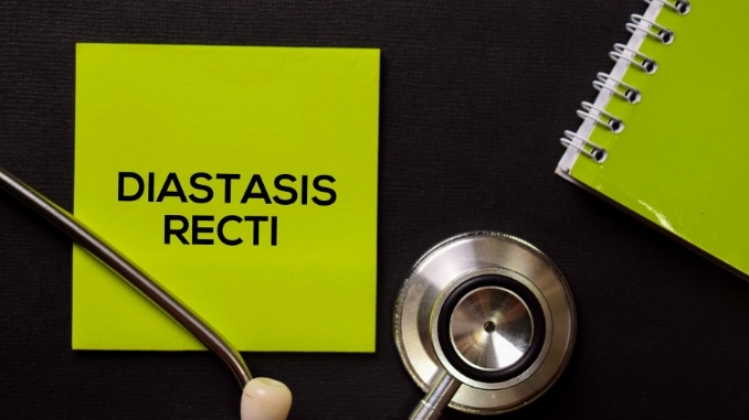 Understanding Diastasis Recti