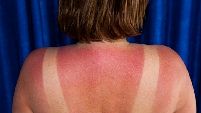 Sunburn and Skin Damage - Bad things about summer